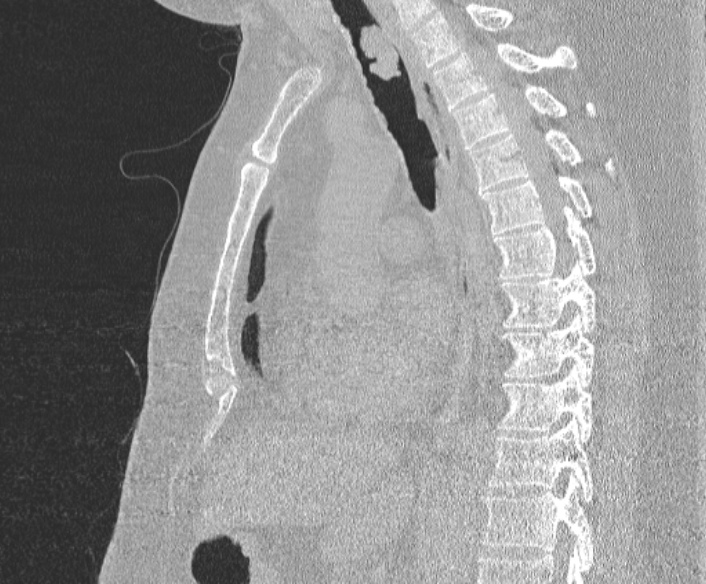 Adenoid cystic carcinoma of the trachea (Radiopaedia 49042-54137 Sagittal lung window 244).jpg
