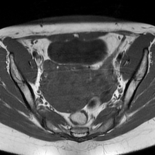 File:Adenoma malignum of cervix (Radiopaedia 66441-75705 Axial T1 4).jpg