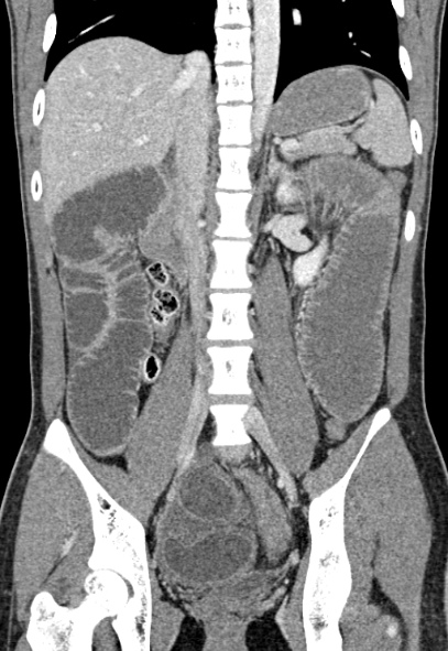 Adhesional small bowel obstruction (Radiopaedia 52107-57980 Coronal C+ portal venous phase 48).jpg
