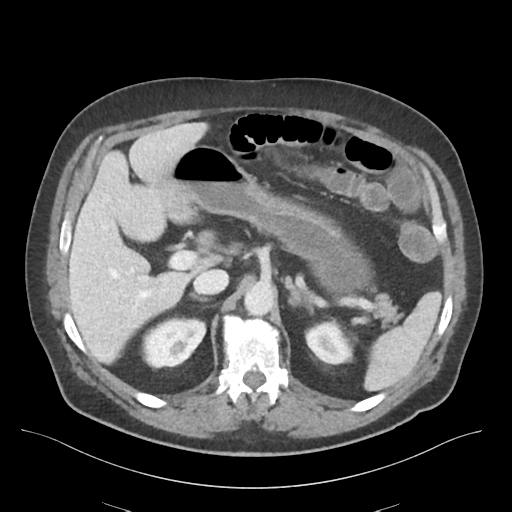 Adhesions within abdominal wall hernia (Radiopaedia 58283-65394 Axial C+ portal venous phase 25).png