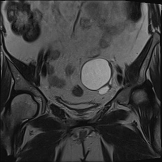 File:Adnexal multilocular cyst (O-RADS US 3- O-RADS MRI 3) (Radiopaedia 87426-103754 Coronal T2 13).jpg
