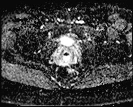 File:Adnexal multilocular cyst (O-RADS US 3. O-RADS MRI 3) (Radiopaedia 87426-103754 Axial 160).jpeg