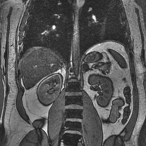 File:Adrenal adenoma (Radiopaedia 10828-11267 Coronal T1 out-of-phase 1).jpg