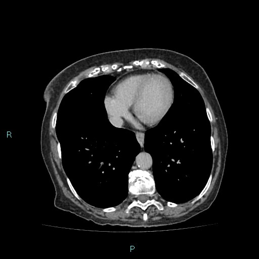 File:Adrenal collision tumor (ACT) (Radiopaedia 48462-53379 Axial C+ delayed 3).jpg