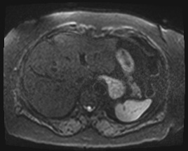 Adrenal cortical carcinoma (Radiopaedia 64017-72770 Axial DWI 48).jpg