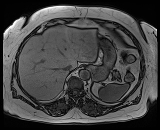 File:Adrenal cortical carcinoma (Radiopaedia 64017-72770 Axial T1 out-of-phase 11).jpg