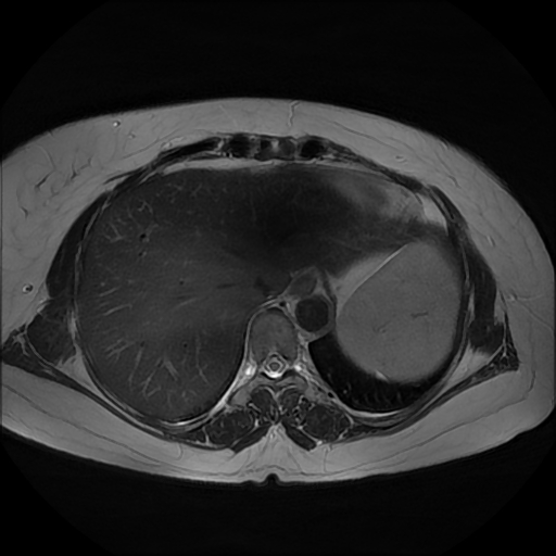 File:Adrenal cortical carcinoma (Radiopaedia 70906-81116 Axial T2 3).jpg