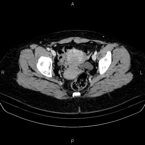 Adrenal cortical carcinoma (Radiopaedia 84882-100379 Axial C+ portal venous phase 87).jpg