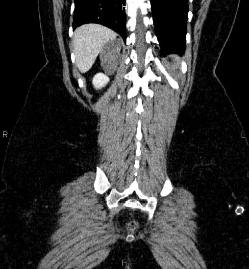 Adrenal cortical carcinoma (Radiopaedia 84882-100379 Coronal C+ portal venous phase 55).jpg