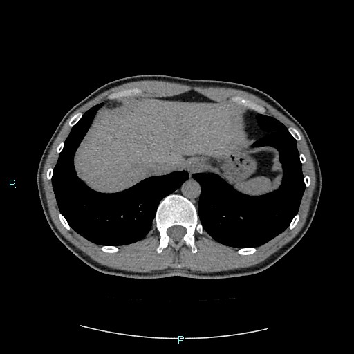 File:Adrenal cystic lymphangioma (Radiopaedia 83161-97534 Axial non-contrast 17).jpg
