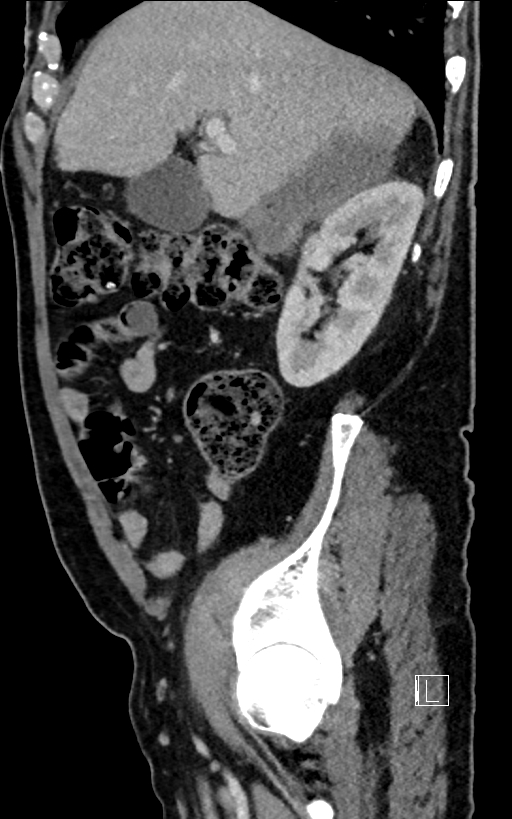Adrenal lymphoma (Radiopaedia 73730-84529 Sagittal C+ portal venous phase 32).jpg