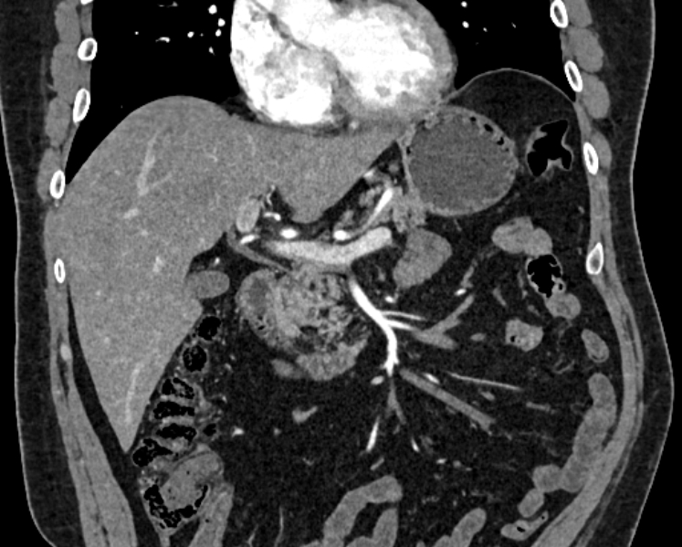 File:Adrenal metastases (Radiopaedia 73082-83791 Coronal C+ arterial phase 3).jpg