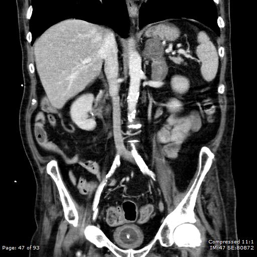 Adrenal metastasis (Radiopaedia 78425-91079 Sagittal C+ portal venous phase 34).jpg