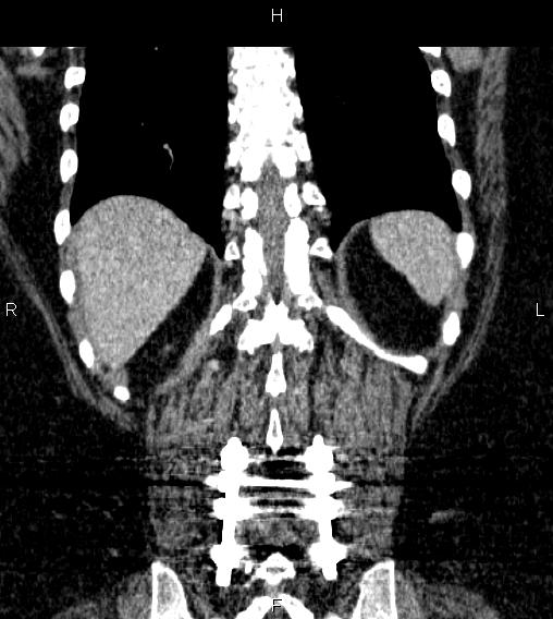 Adrenal myelolipoma (Radiopaedia 84319-99617 Coronal renal cortical phase 65).jpg