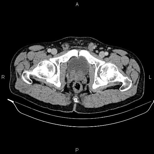 Adrenal myelolipoma (Radiopaedia 87794-104246 Axial renal cortical phase 106).jpg