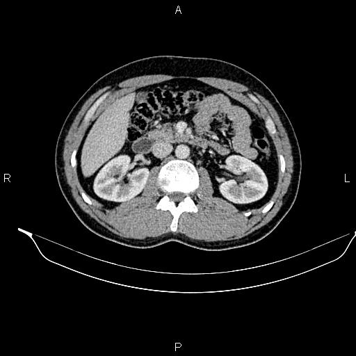File:Adrenal myelolipoma (Radiopaedia 87794-104246 Axial renal cortical phase 44).jpg