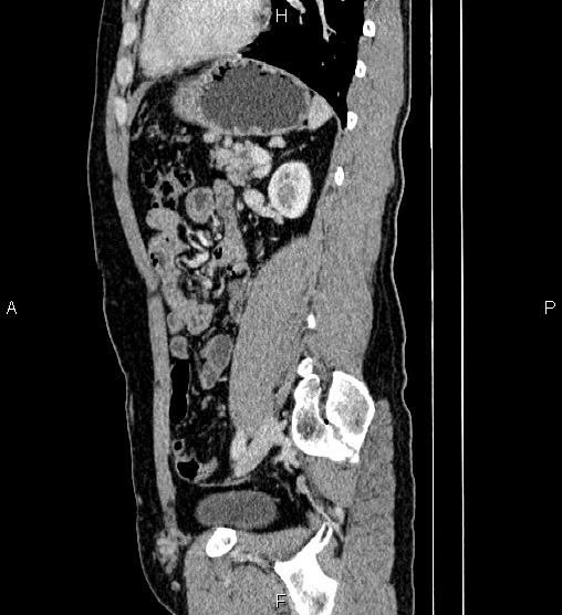 Adrenal myelolipoma (Radiopaedia 87794-104246 Sagittal renal cortical phase 63).jpg