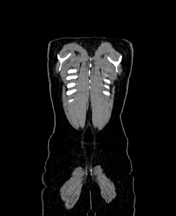 Adrenocortical carcinoma (Radiopaedia 80134-93438 Coronal C+ portal venous phase 159).jpg