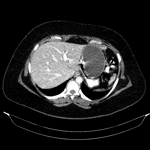 File:Afferent loop syndrome - secondary to incarcerated trocar site hernia (Radiopaedia 82959-97305 Axial C+ portal venous phase 44).jpg