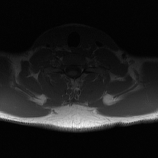 File:Aggressive vertebral hemangioma (Radiopaedia 39937-42404 Axial T1 41).png