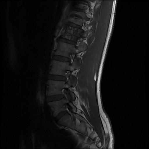 File:Aggressive vertebral hemangioma with pathological fracture (Radiopaedia 69528-79411 Sagittal T1 2).jpg