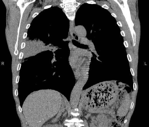 Air bronchogram in pneumonia (Radiopaedia 85719-101512 Coronal non-contrast 34).jpg