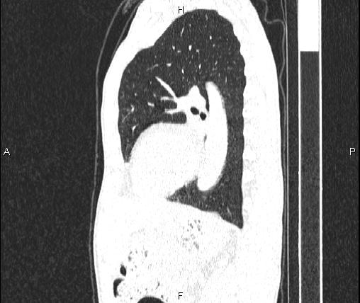 Air bronchogram in pneumonia (Radiopaedia 85719-101512 Sagittal lung window 64).jpg
