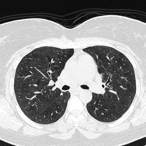 Air trapping in small airway disease (Radiopaedia 61685-69694 Axial lung window 71).jpg