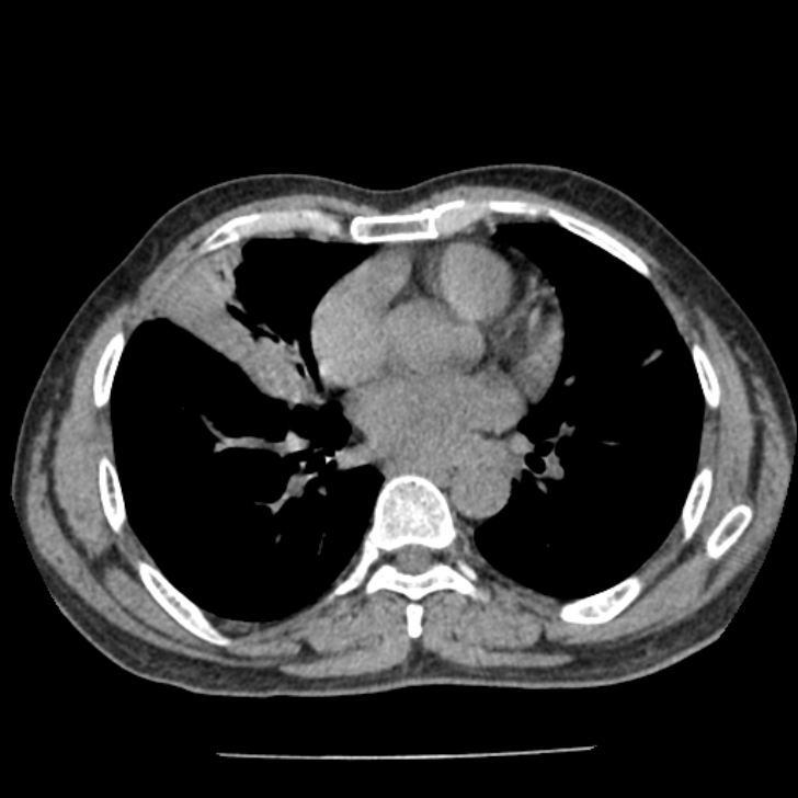Airway foreign body in adult (Radiopaedia 85907-101779 Axial liver window 107).jpg