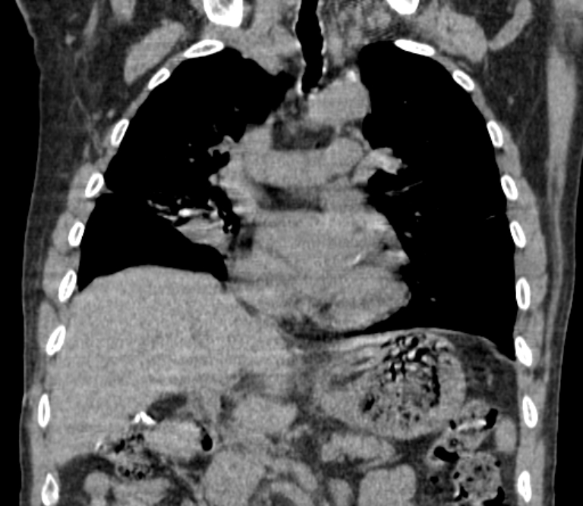 Airway foreign body in adult (Radiopaedia 85907-101779 Coronal liver window 120).jpg