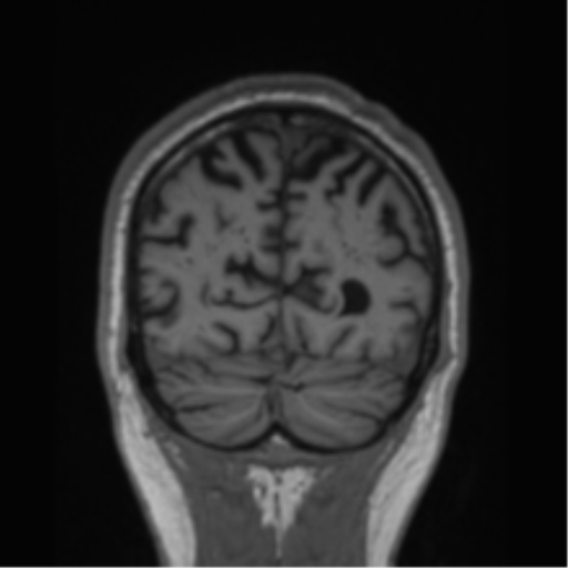 Alzheimer's disease- with Gerstmann syndrome and dressing apraxia (Radiopaedia 54882-61150 Coronal T1 18).png