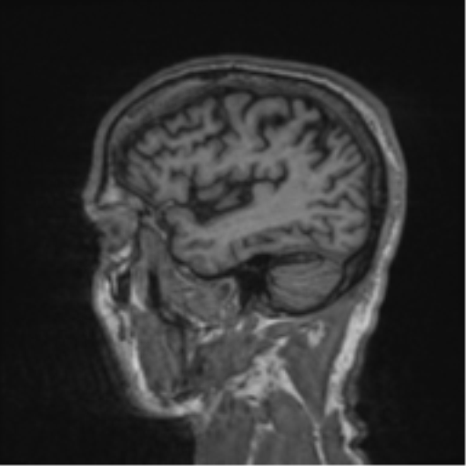 File:Alzheimer's disease- with apraxia (Radiopaedia 54763-61011 Sagittal T1 56).png