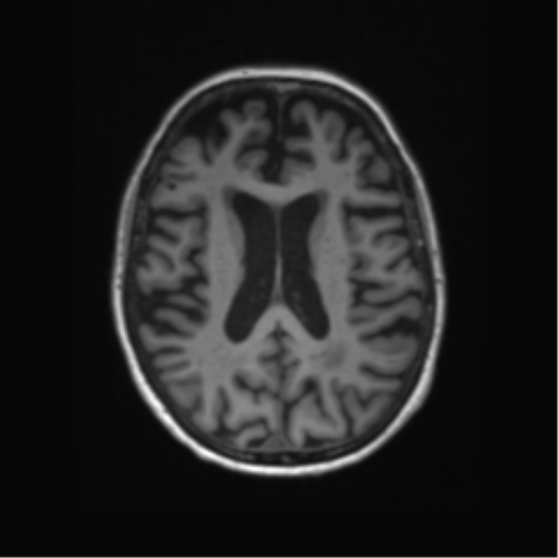 File:Alzheimer's disease (Radiopaedia 42658-45802 Axial T1 66).png