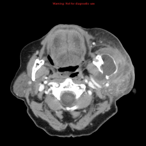 Ameloblastoma (Radiopaedia 27437-27631 A 34).jpg