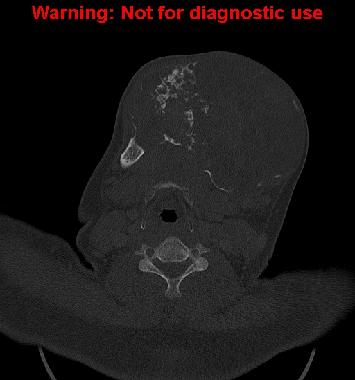 Ameloblastoma (Radiopaedia 33126-34164 Axial bone window 22).jpg
