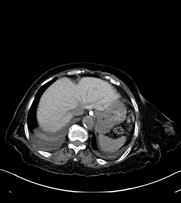 Amiodarone deposition in the liver (Radiopaedia 77587-89780 Axial non-contrast 70).jpg