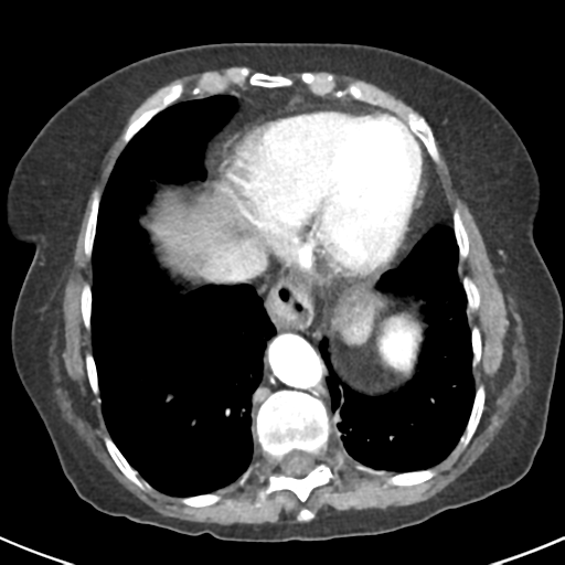 Ampullary adenocarcinoma (Radiopaedia 34013-35237 B 6).png