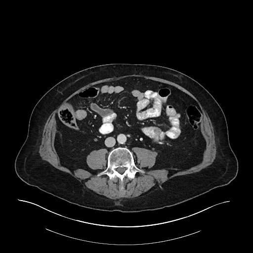 Ampullary adenocarcinoma (Radiopaedia 59373-66734 C 95).jpg
