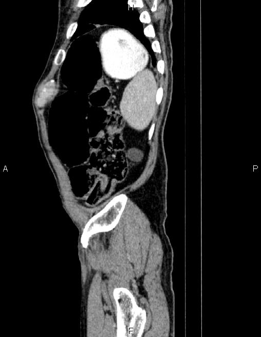 Ampullary adenocarcinoma (Radiopaedia 86093-102032 D 87).jpg