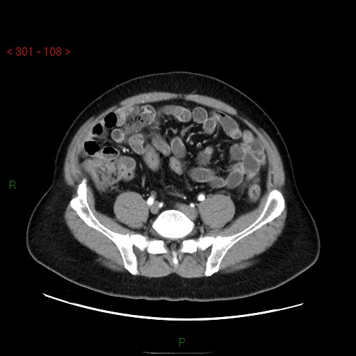 File:Ampullary carcinoma (Radiopaedia 56396-63056 B 54).jpg