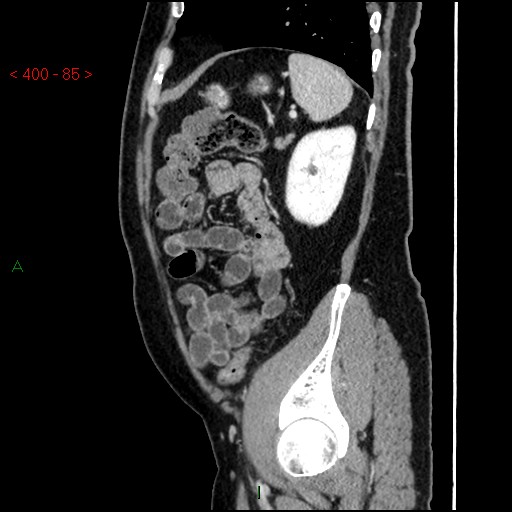 Ampullary carcinoma (Radiopaedia 56396-63056 D 84).jpg
