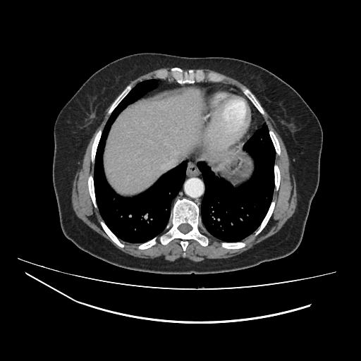 Ampullary tumor (Radiopaedia 60333-67998 A 2).jpg