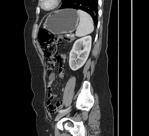 File:Ampullary tumor (Radiopaedia 60333-67998 C 46).jpg