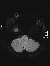 File:Amyotrophic lateral sclerosis (Radiopaedia 70821-81017 Axial SWI minIP 3).jpg