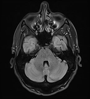 File:Amyotrophic lateral sclerosis (Radiopaedia 87352-103658 Axial FLAIR 7).jpg