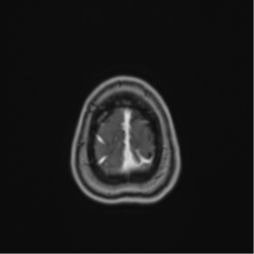 Anaplastic astroblastoma (Radiopaedia 55666-62194 Axial T1 C+ 70).png