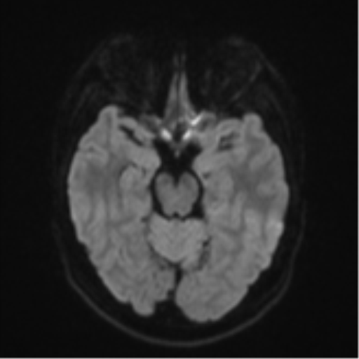 Anaplastic astrocytoma (Radiopaedia 57768-64731 Axial DWI 38).png