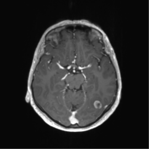 File:Anaplastic astrocytoma (Radiopaedia 86943-103160 Axial T1 C+ 13).png