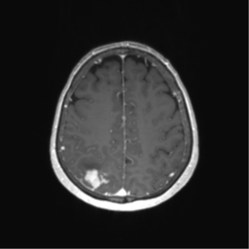 File:Anaplastic astrocytoma (Radiopaedia 86943-103160 Axial T1 C+ 59).png