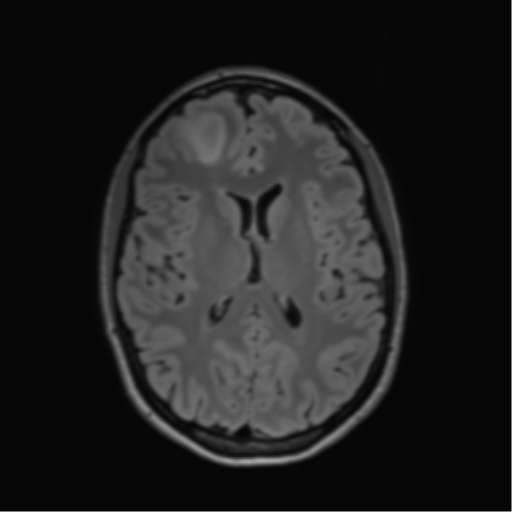 File:Anaplastic astrocytoma IDH mutant (Radiopaedia 50046-55341 Axial FLAIR 29).png